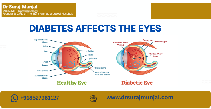 When Diabetes Affects the Eyes: Early Warning Signs & Treatments Explained by Dr. Suraj Munjal